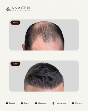 Slider image (5) Anagen - Hair Transplant Clinic in Switzerland